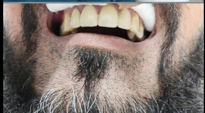 Smile refresh — after