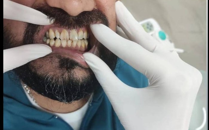Smile refresh — before