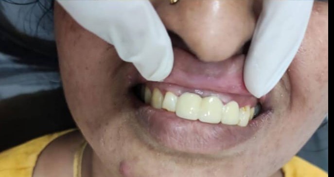 Orthodontic improvement — after