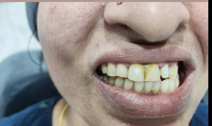 Orthodontic improvement — before