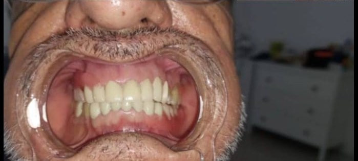 Restorative smile update — after