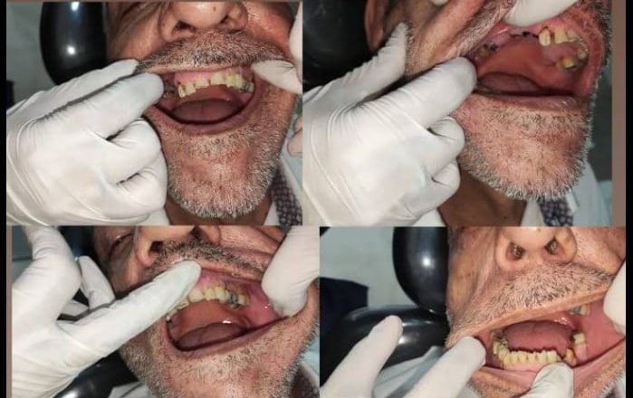 Restorative smile update — before